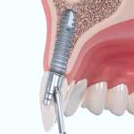 IMPLANT MEDENTIKA