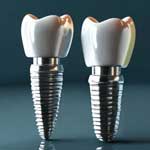 IMPLANT NUVO