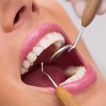 COROANE DENTARE